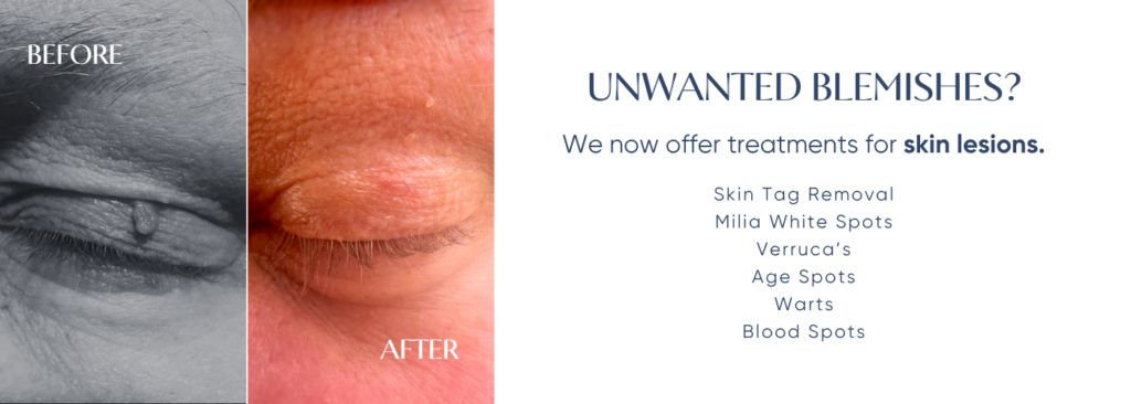 Sue Shields Spa - Web Banner-92 Unwanted Blemishes
